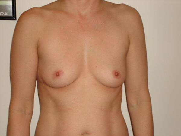 Breast Augmentation Before & After