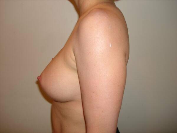 Breast Augmentation Before & After