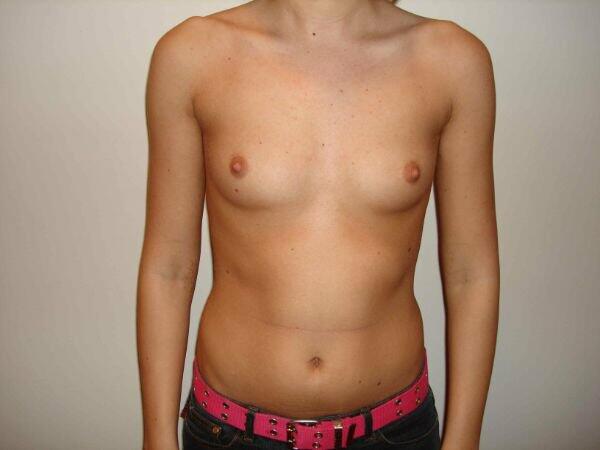 Breast Augmentation Before & After