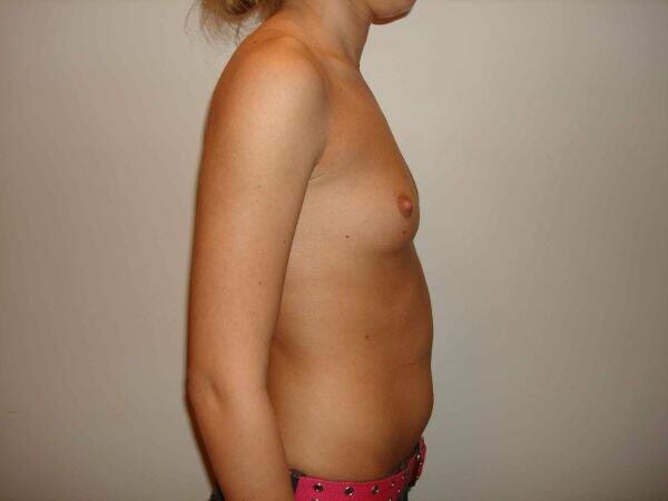 Breast Augmentation Before & After