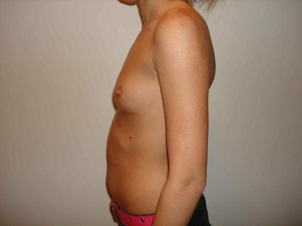 Breast Augmentation Before & After