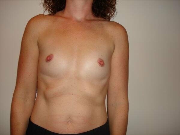 Breast Augmentation Before & After