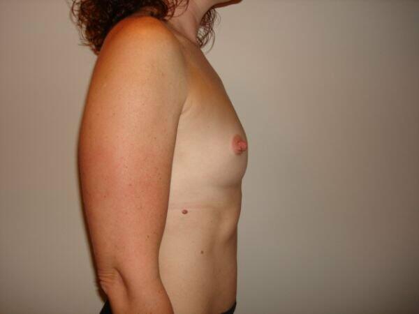 Breast Augmentation Before & After