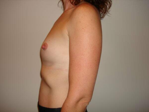 Breast Augmentation Before & After