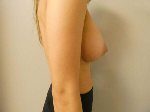 Breast Augmentation Before & After