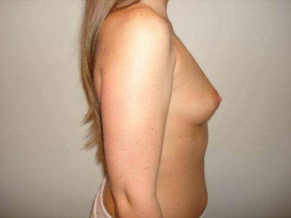 Breast Augmentation Before & After