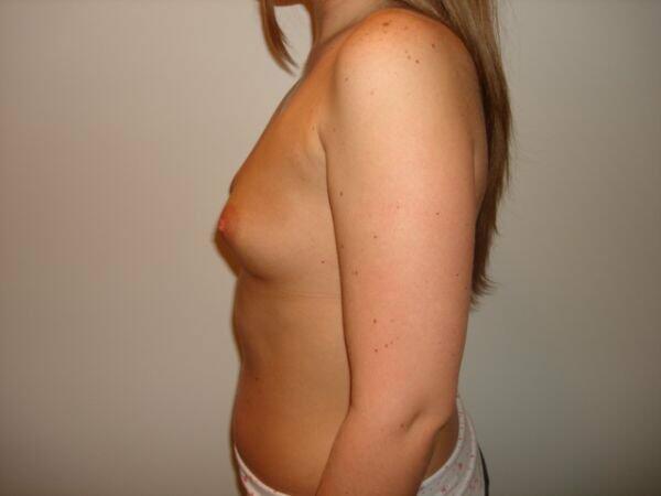 Breast Augmentation Before & After