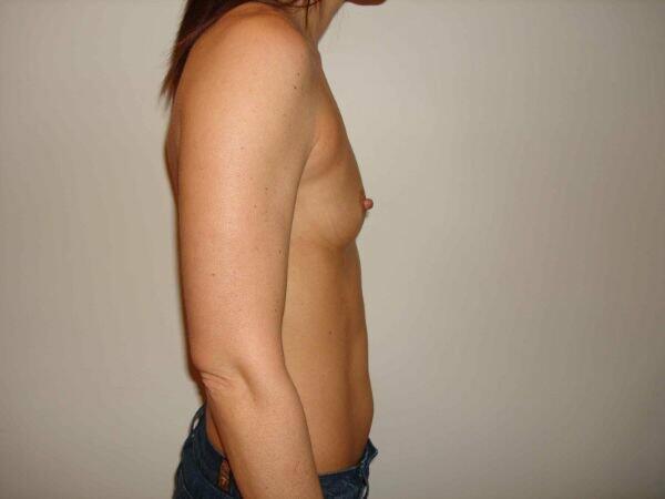 Breast Augmentation Before & After