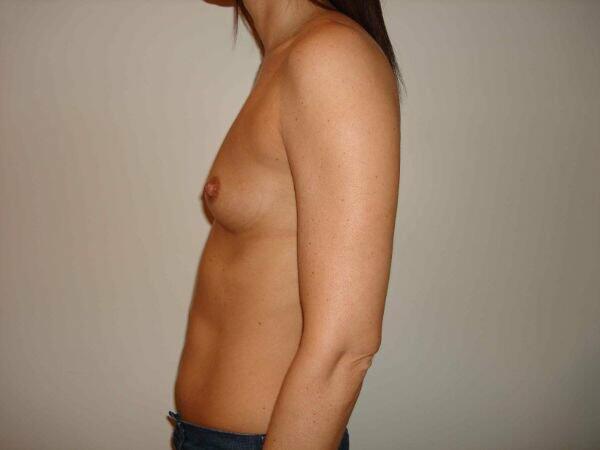 Breast Augmentation Before & After