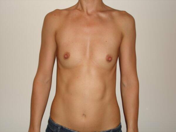 Breast Augmentation Before & After