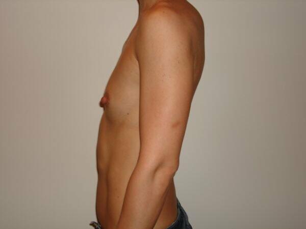 Breast Augmentation Before & After