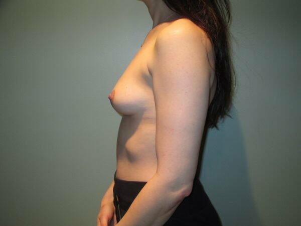 Breast Augmentation Before & After