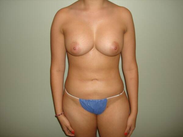 Breast Augmentation Before & After