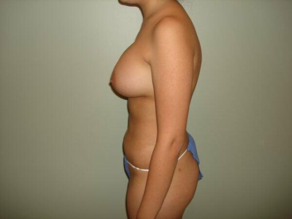 Breast Augmentation Before & After