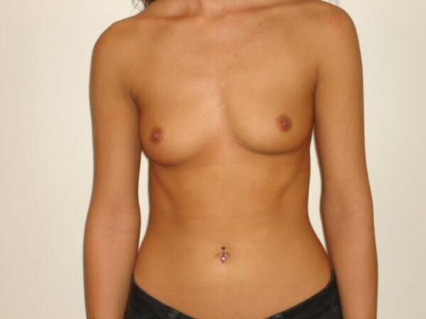 Breast Augmentation Before & After