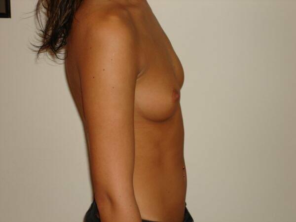 Breast Augmentation Before & After