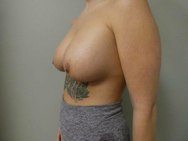 Breast Augmentation Before & After