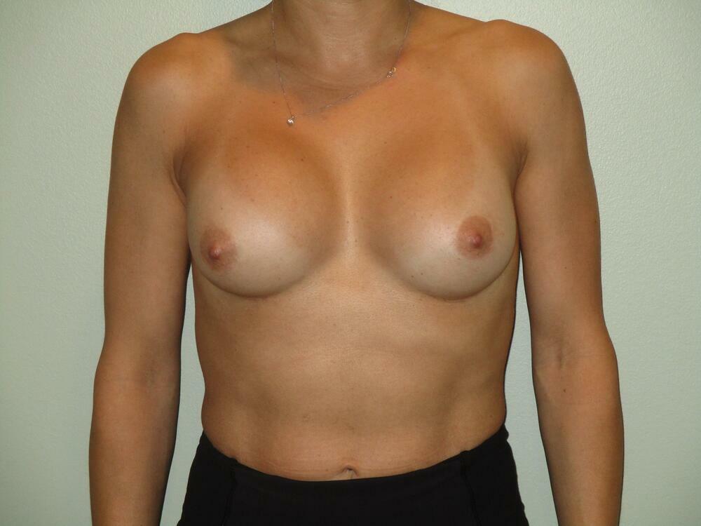 Breast Implant Revision Before & After