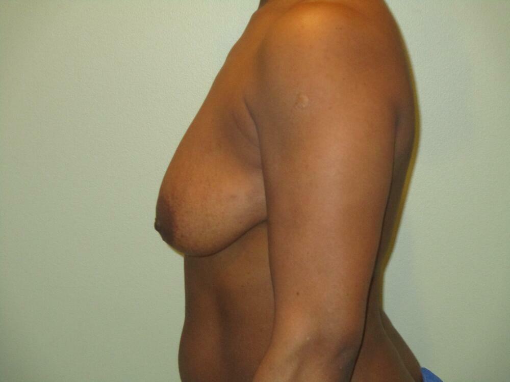 Breast Lift  Before & After