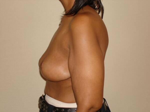 Breast Lift  Before & After