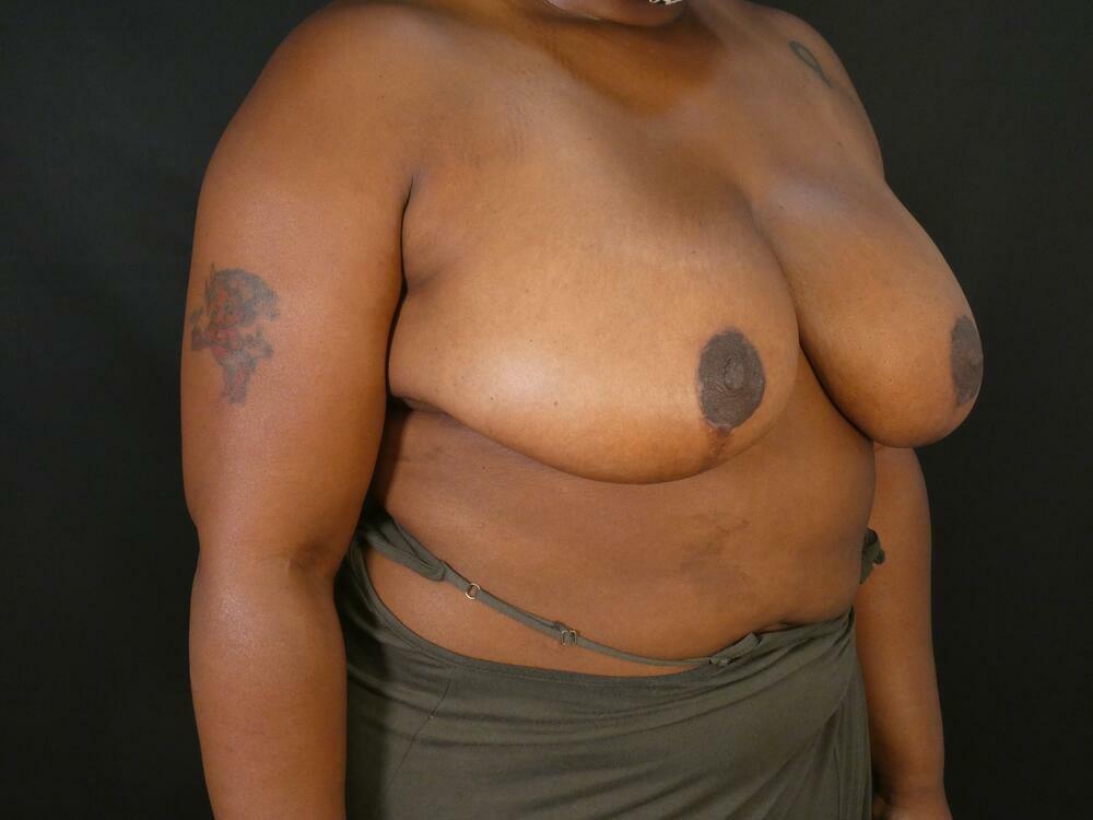 Breast Reduction Before & After