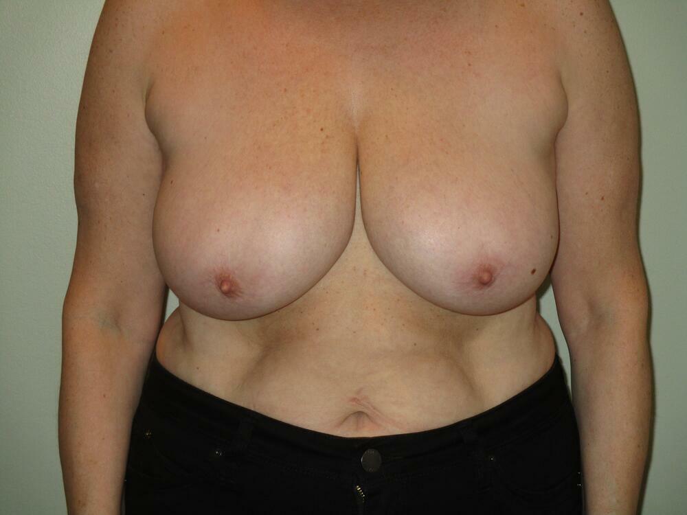 Breast Reduction Before & After