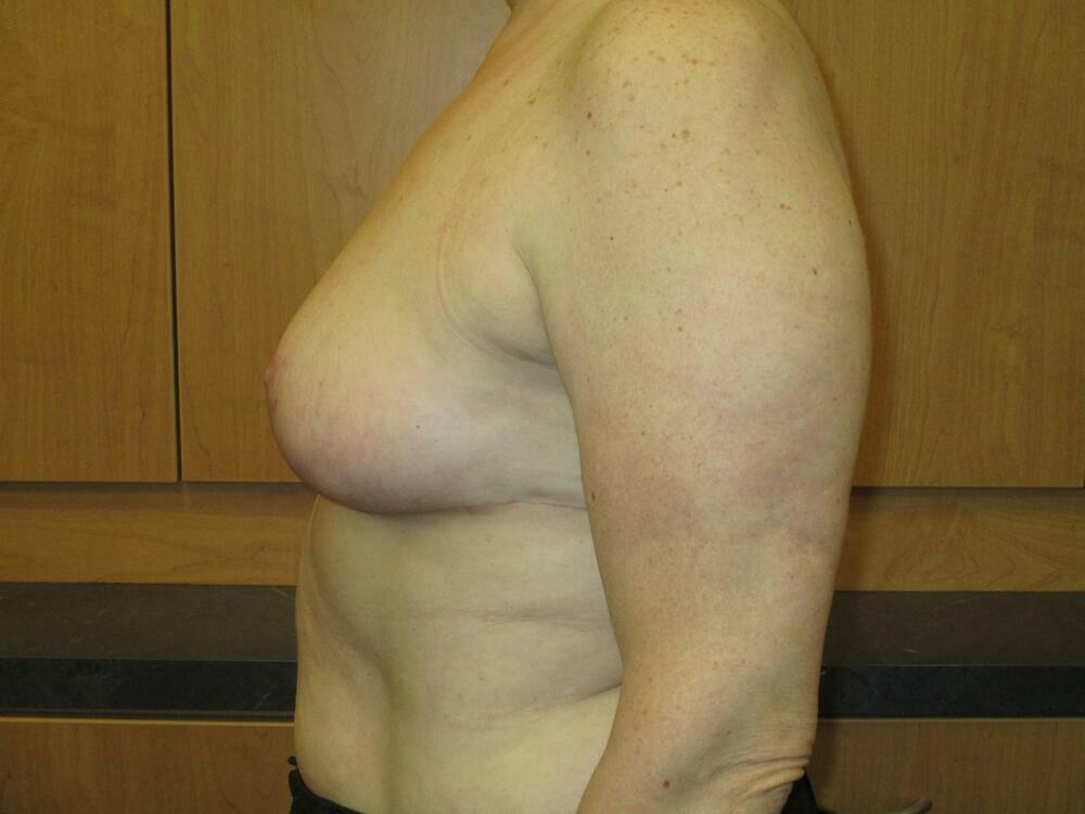 Breast Reduction Before & After