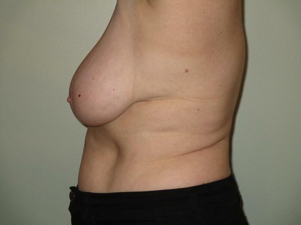 Breast Reduction Before & After