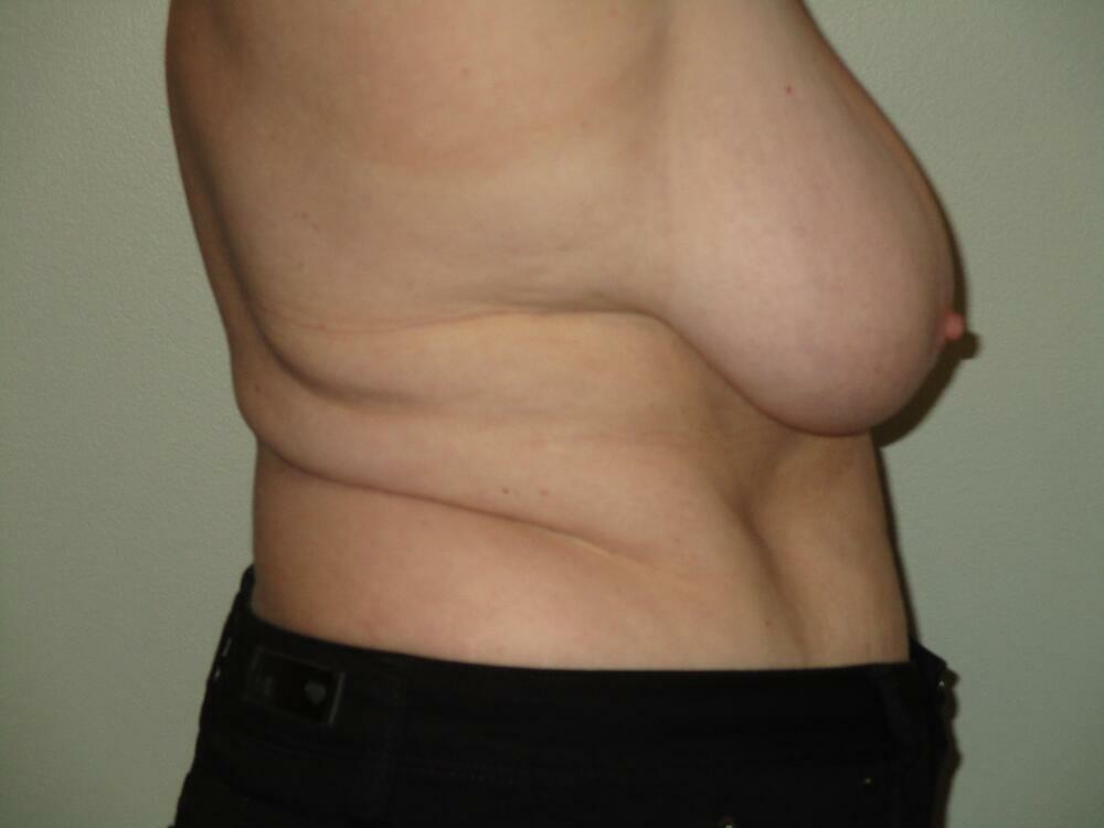 Breast Reduction Before & After