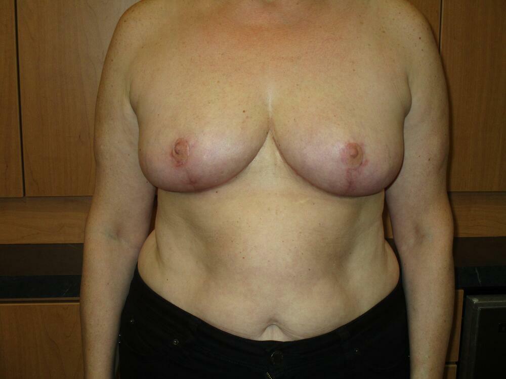 Breast Reduction Before & After