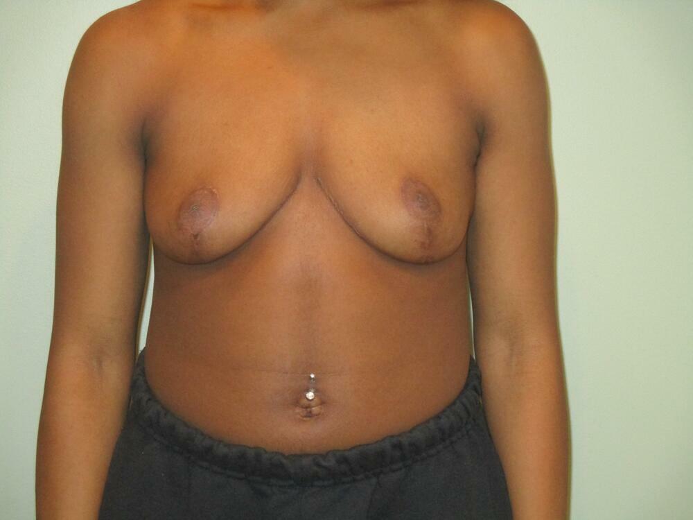 Breast Reduction Before & After