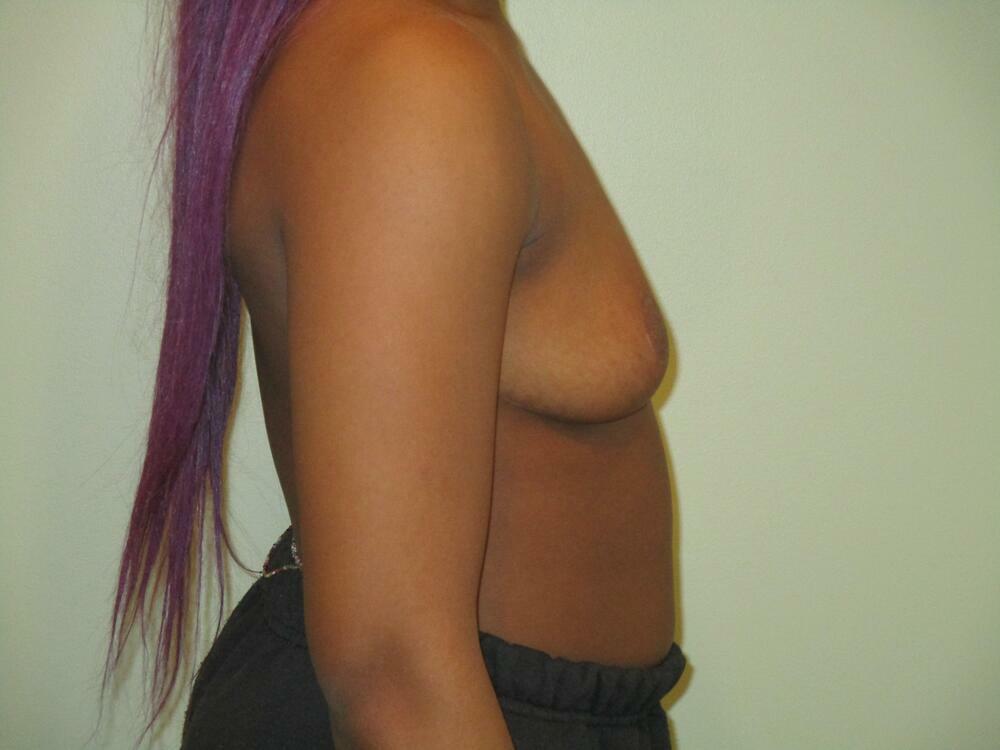 Breast Reduction Before & After