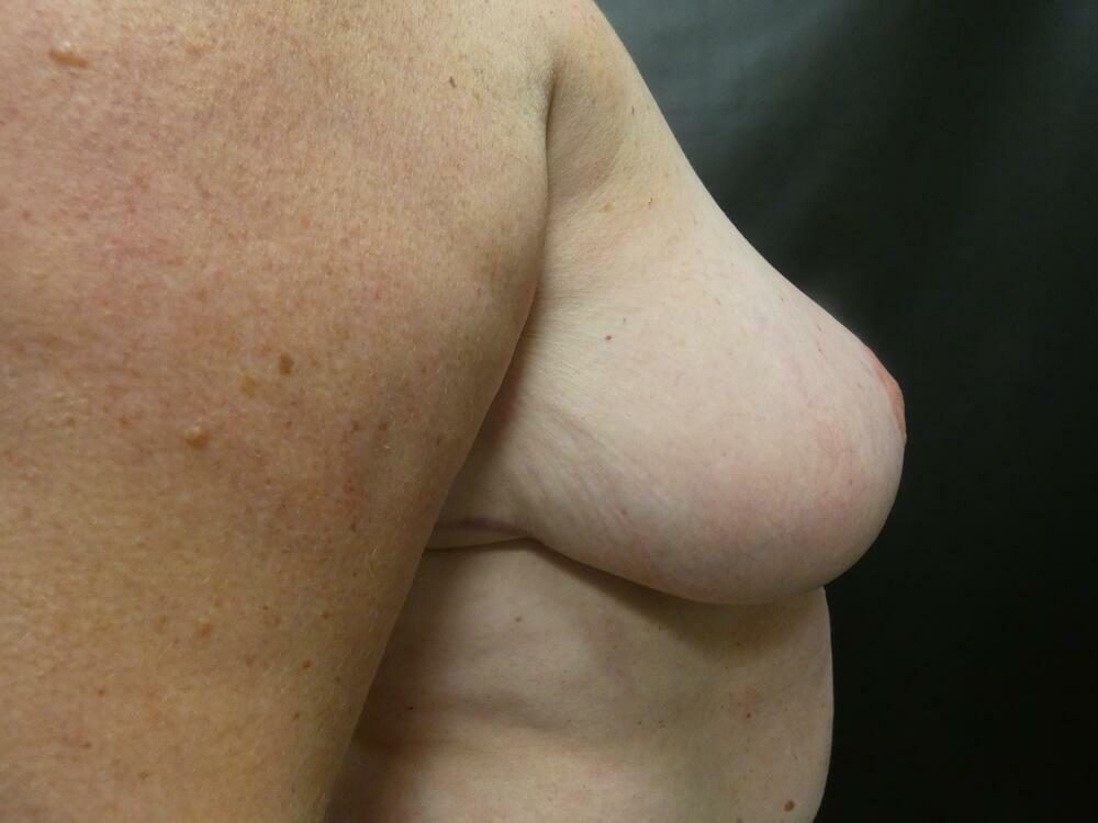 Breast Reduction Before & After