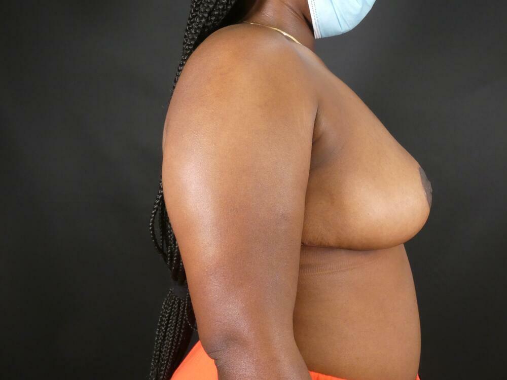 Breast Reduction Before & After