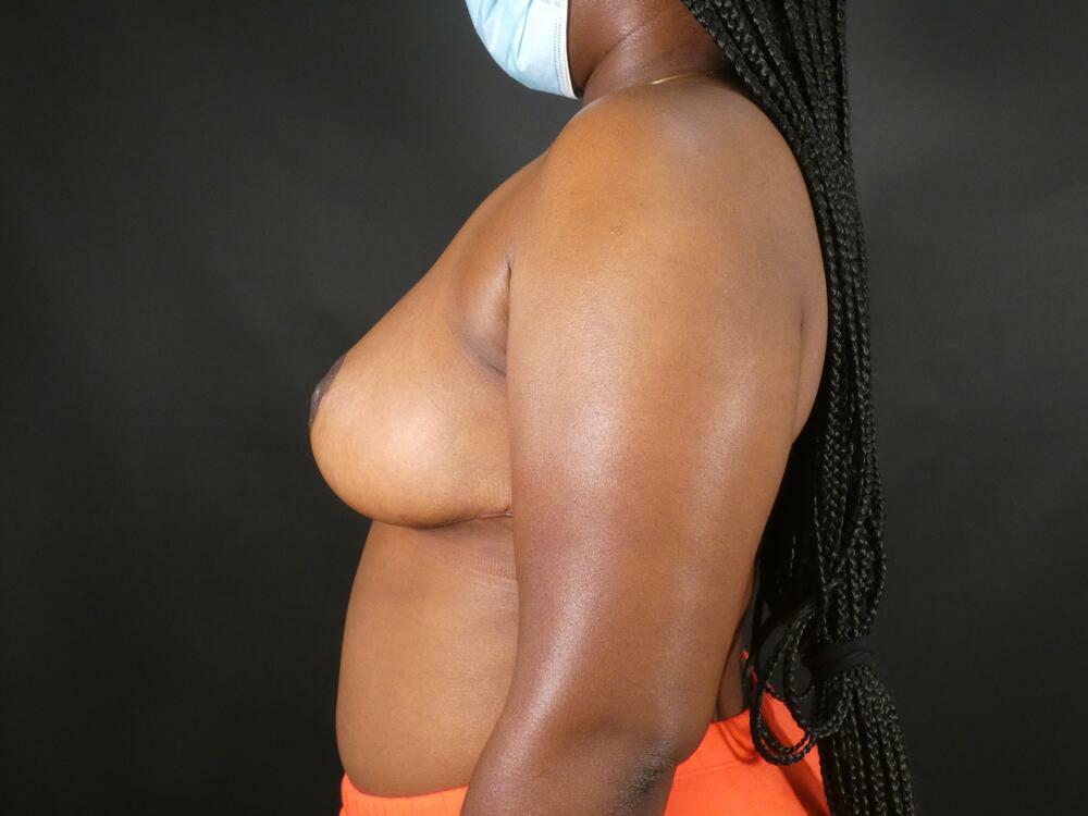 Breast Reduction Before & After