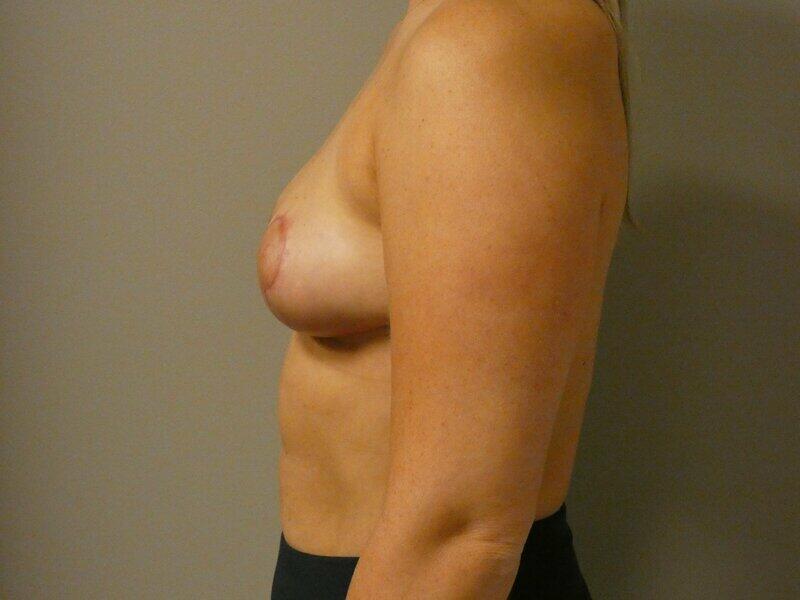 Breast Reduction Before & After