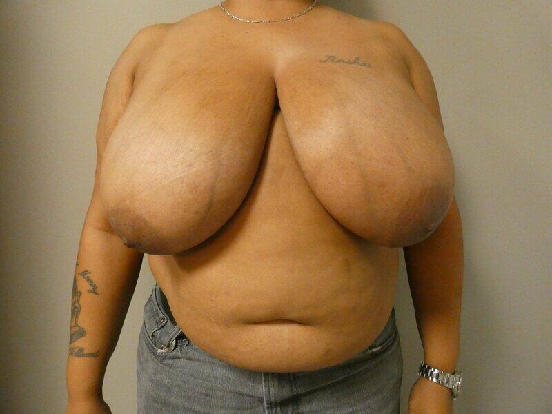 Breast Reduction Before & After