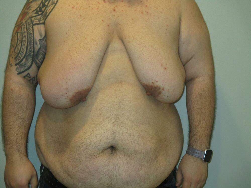 Gynecomastia Correction Before & After