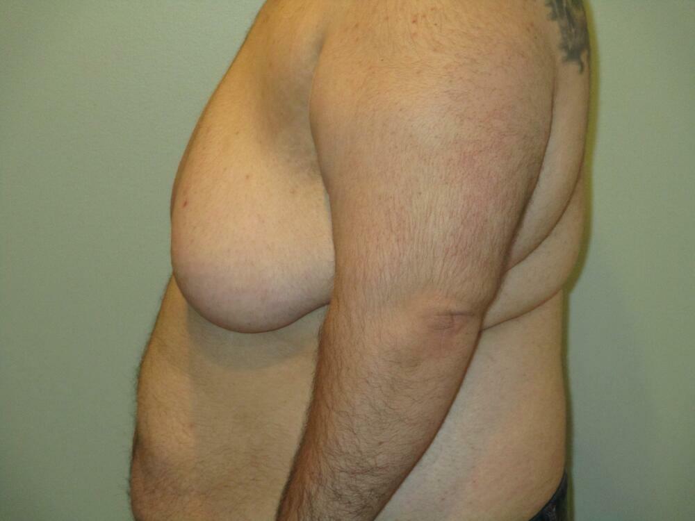 Gynecomastia Correction Before & After