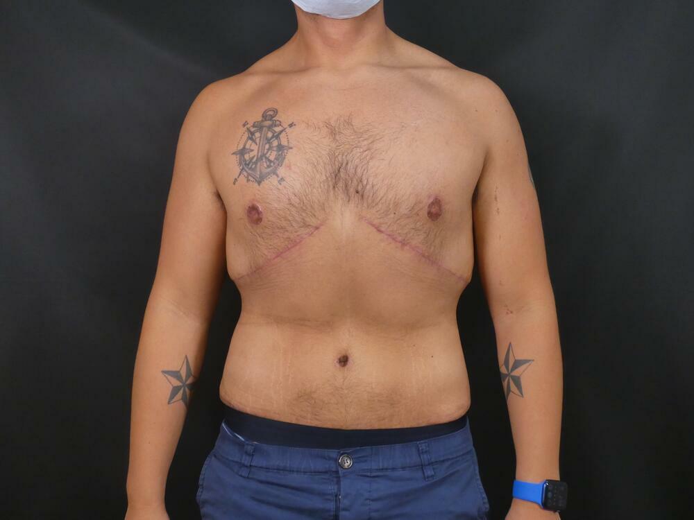 Gynecomastia Correction Before & After