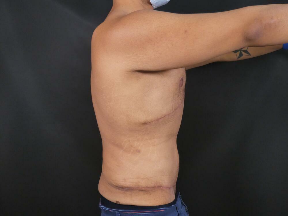 Gynecomastia Correction Before & After