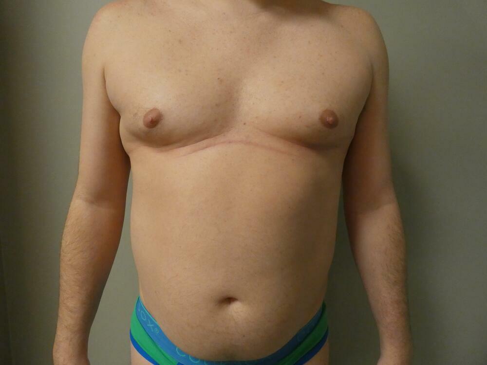 Gynecomastia Correction Before & After