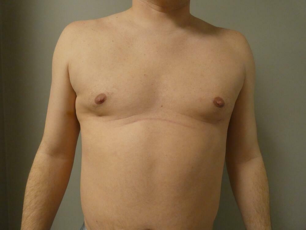 Gynecomastia Correction Before & After