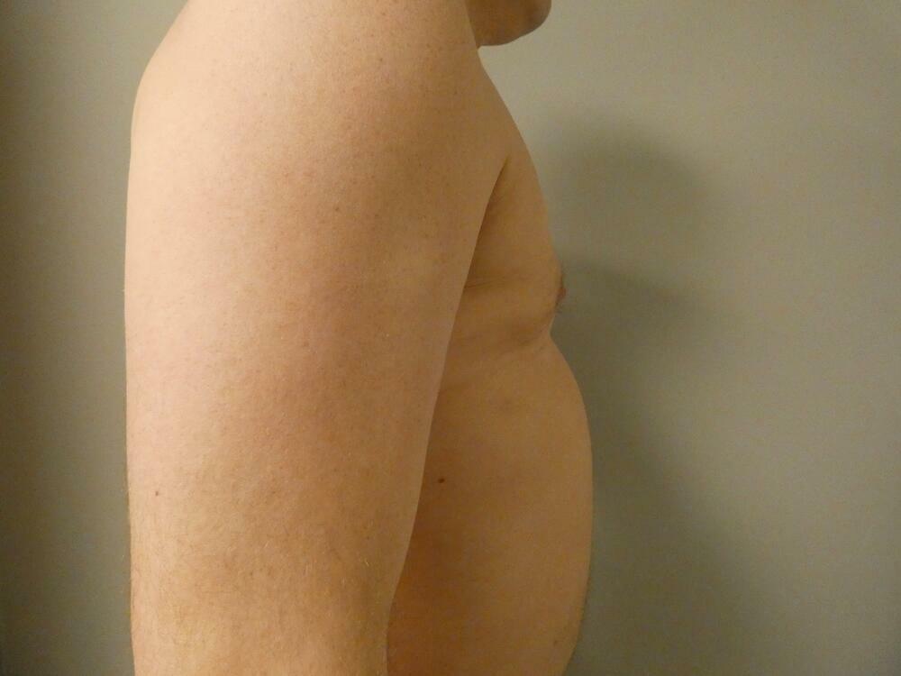 Gynecomastia Correction Before & After