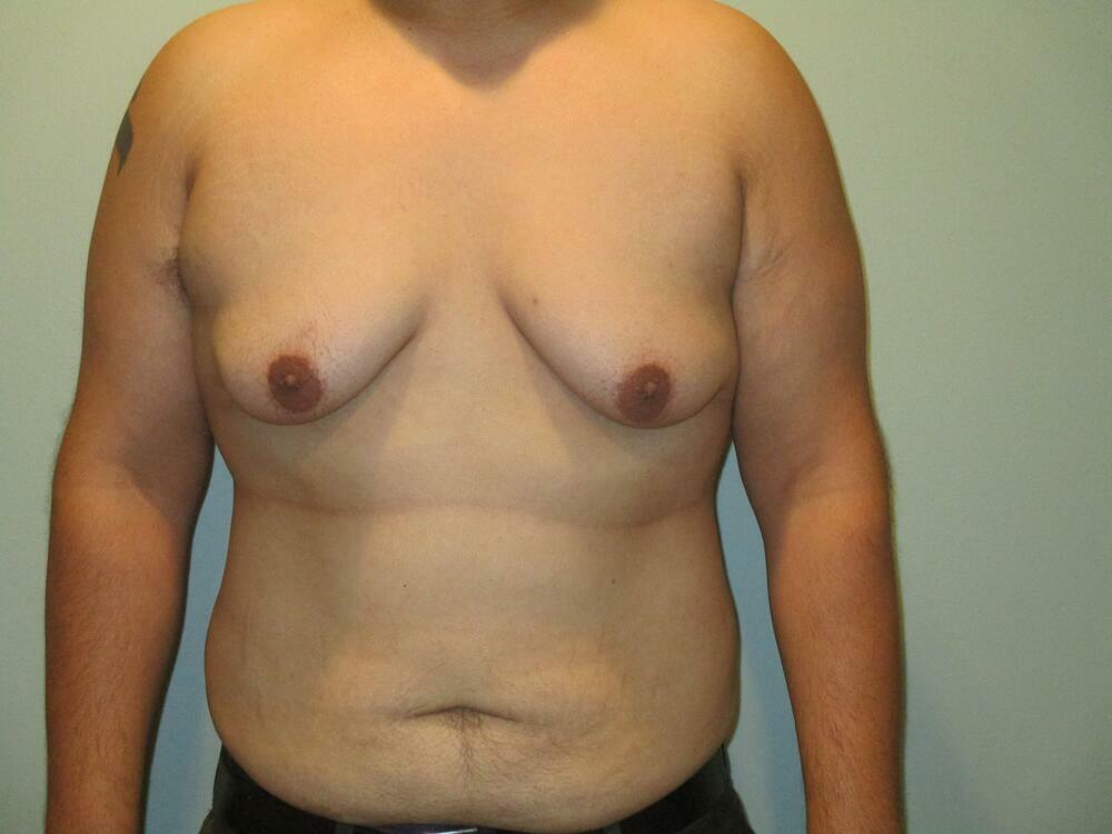 Gynecomastia Correction Before & After