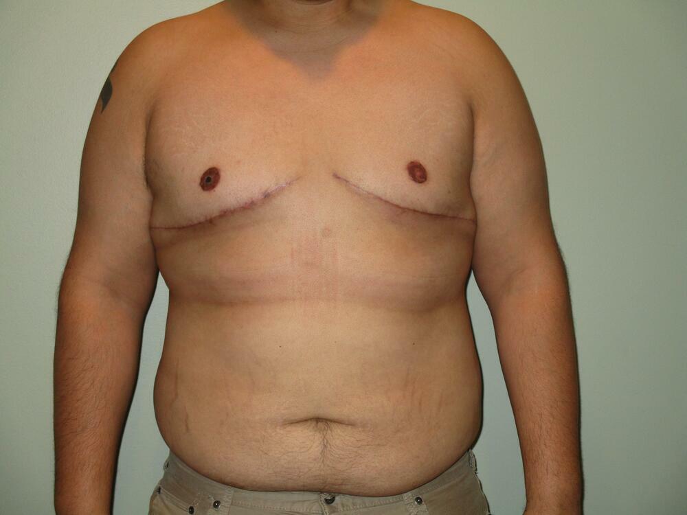 Gynecomastia Correction Before & After