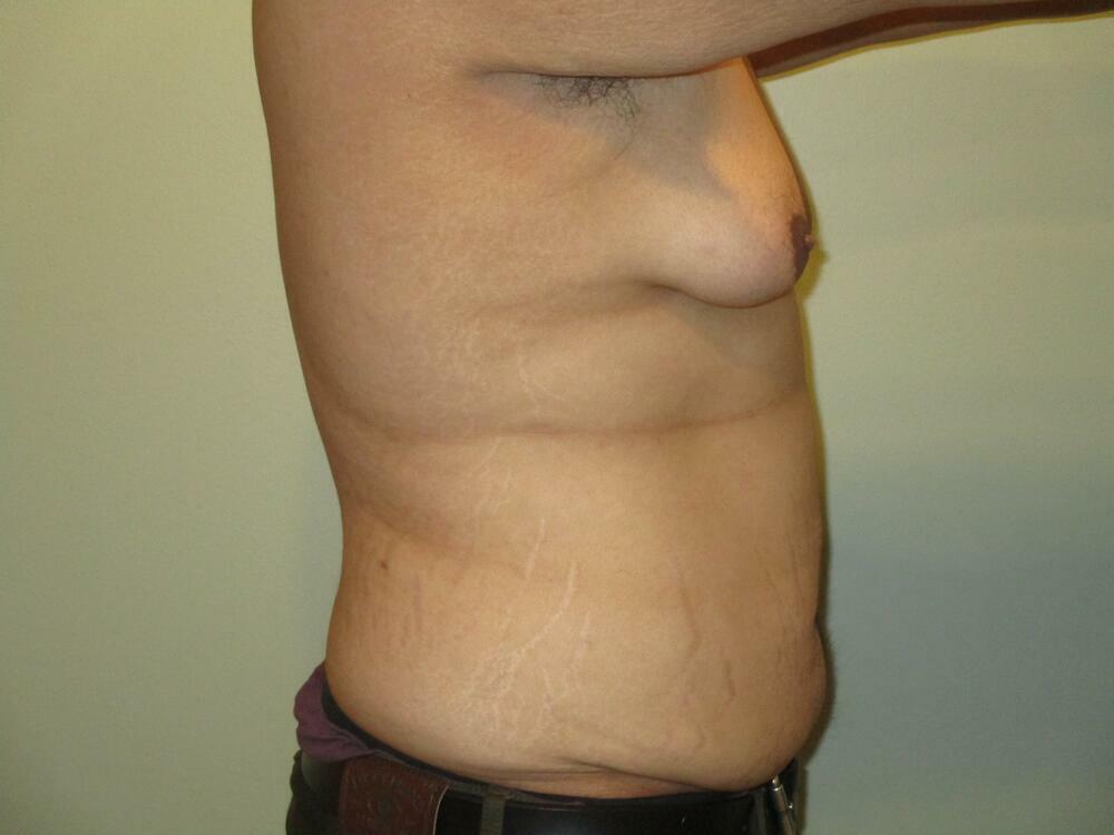 Gynecomastia Correction Before & After