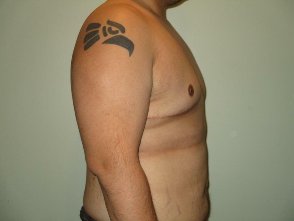 Gynecomastia Correction Before & After