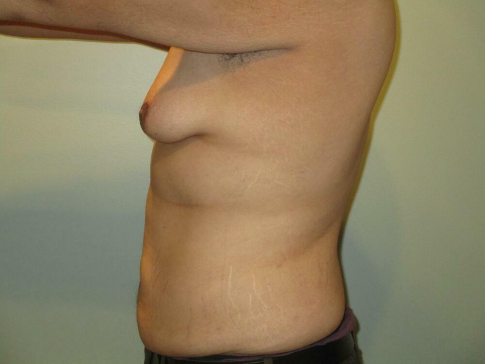 Gynecomastia Correction Before & After