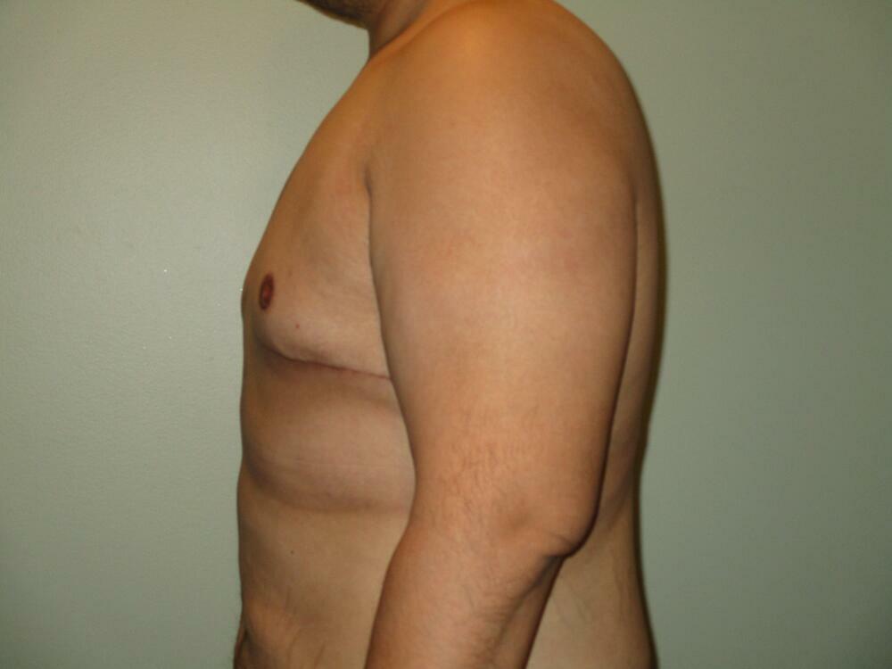 Gynecomastia Correction Before & After